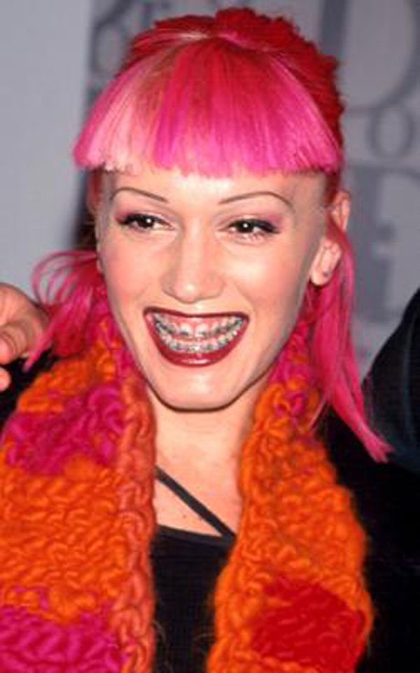 gwen stefani before and after braces